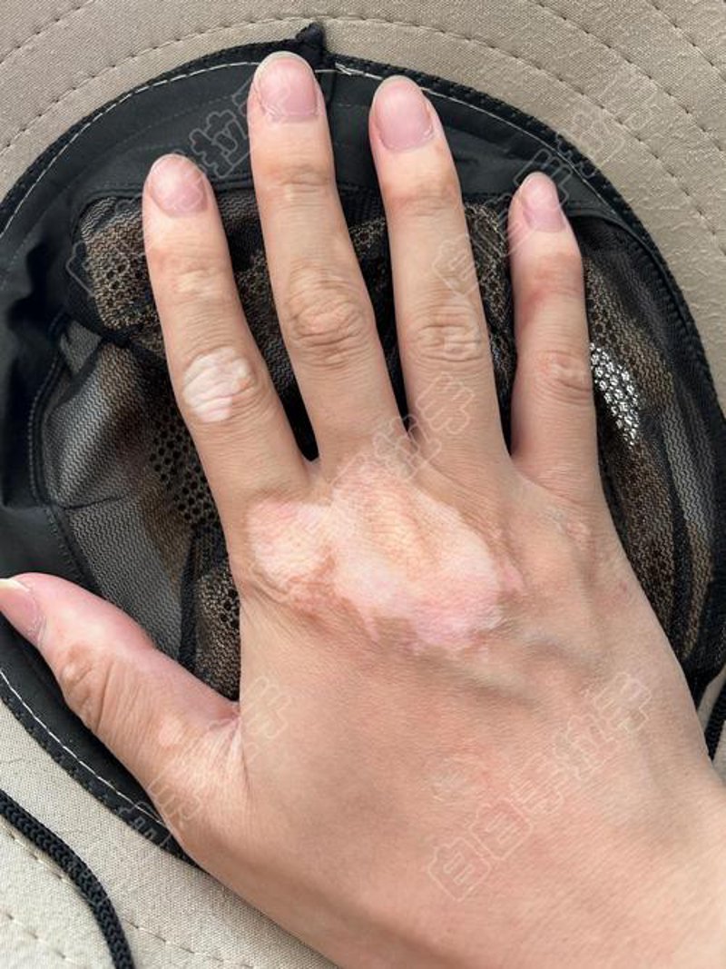 聚焦白癜风治疗前沿：寻找最有效的康复方案
