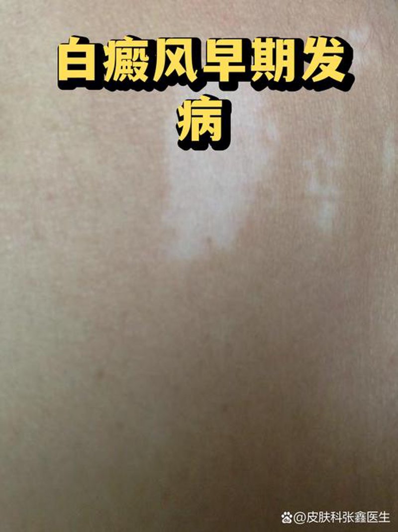 白癜风治疗方法