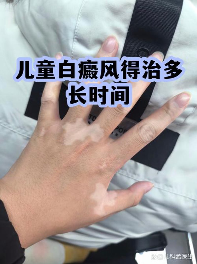 白癜风治疗：了解三大常见误区