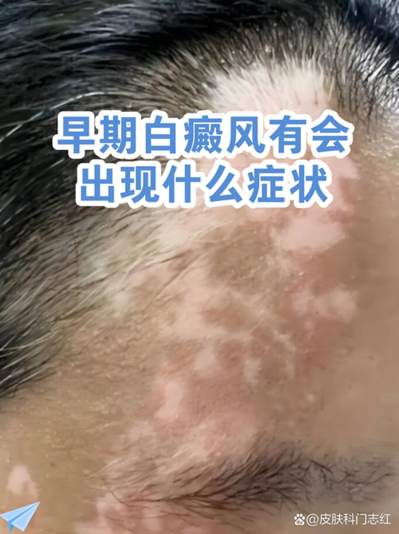 白癜风治疗案例分析：寻找生活的那束光