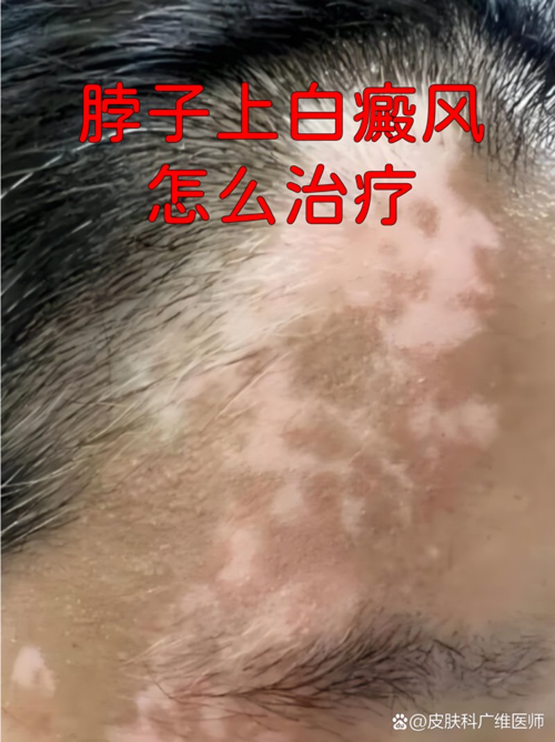 白癜风患儿的治疗曙光：如何选择专业医院？