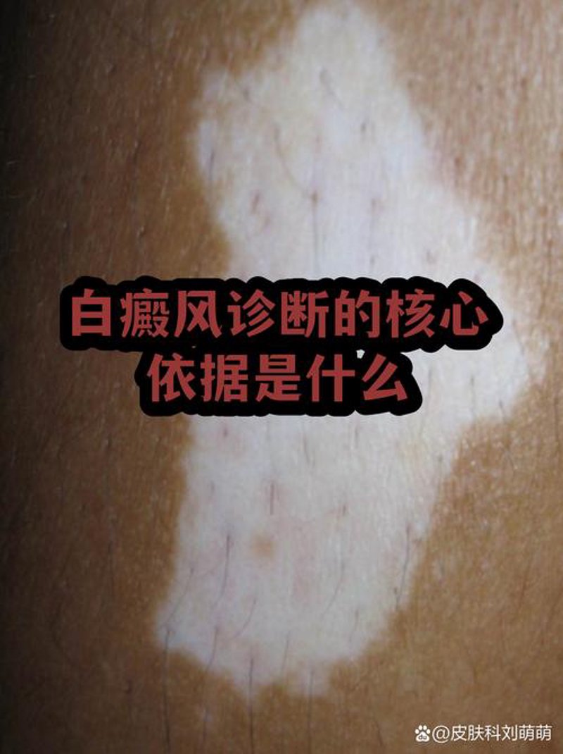 聚焦白癜风研究前沿,环亚研究院开启科学治疗新篇章